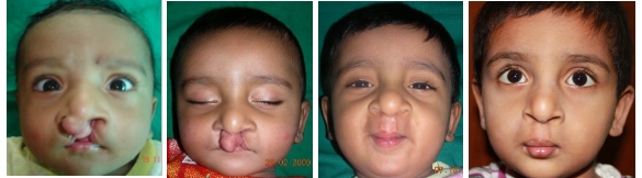 before after cleft surgery
