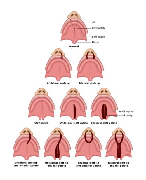 cleft chart